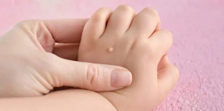 Syylä ilmestyy tavallisimmin käsiin tai jalkoihin.